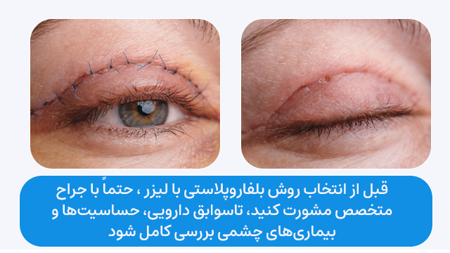 قبل از انتخاب روش بلفاروپلاستی با لیزر ، حتماً با جراح متخصص مشورت کنید، تا سوابق دارویی، حساسیتها و بیماریهای چشمی بررسی کامل شود.