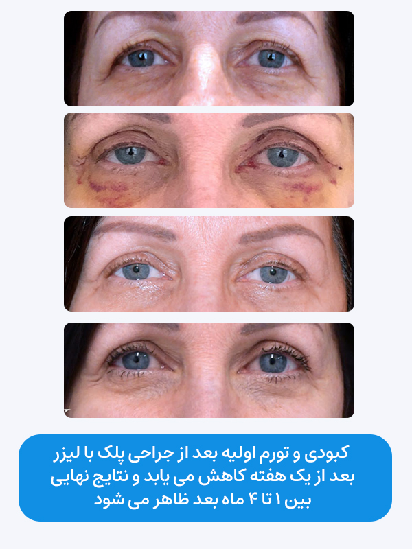 کبودی و تورم اولیه بعد از جراحی پلک با لیزر بعد از یک هفته کاهش می یابد و نتایج نهایی بین 1 تا 4 ماه بعد ظاهر می شود.