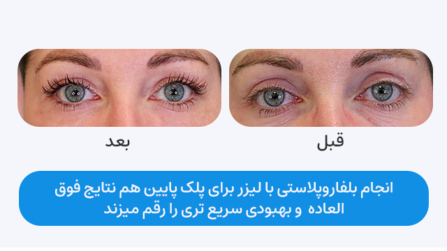 انجام بلفاروپلاستی با لیزر co2 برای پلک پایین هم نتایج فوق العاده و بهبودی سریع تری را رقم میزند.