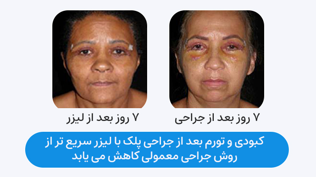 کبودی و تورم بعد از جراحی پلک با لیزر سریع تر از روش جراحی معمولی کاهش می یابد.