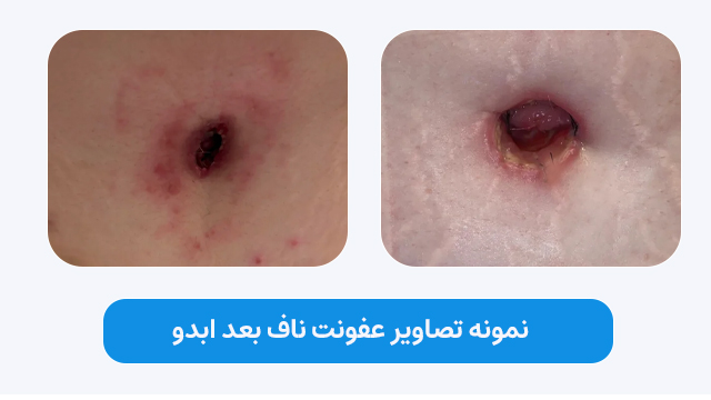 نمونه تصاویر عفونت ناف بعد ابدو
