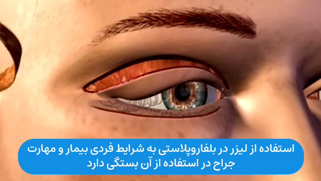 استفاده از لیزر در بلفاروپلاستی به شرایط فردی بیمار و مهارت جراح در استفاده از آن بستگی دارد.