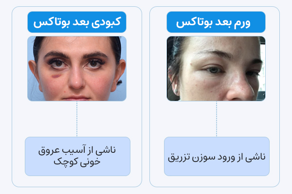 ورم و کبودی بعد از بوتاکس