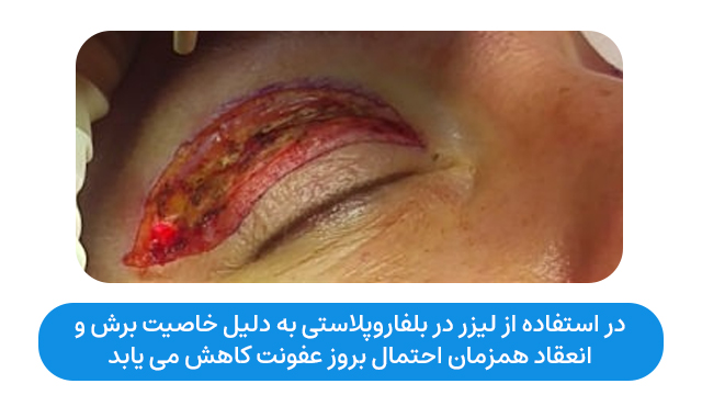 استفاده از لیزر به دلیل خاصیت برش و انعقاد همزمان احتمال بروز عفونت کاهش می یابد.