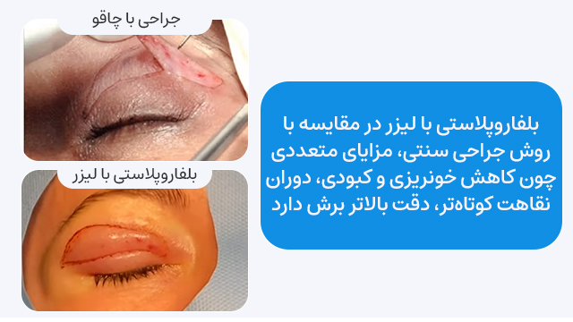 بلفاروپلاستی با لیزر بهتره یا جراحی؟