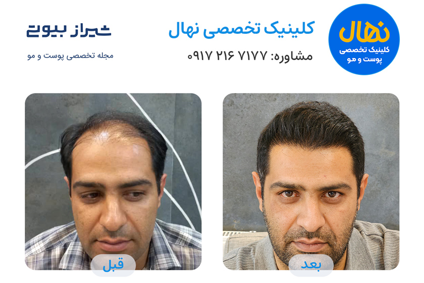 کلینیک کاشت موی نهال شیراز