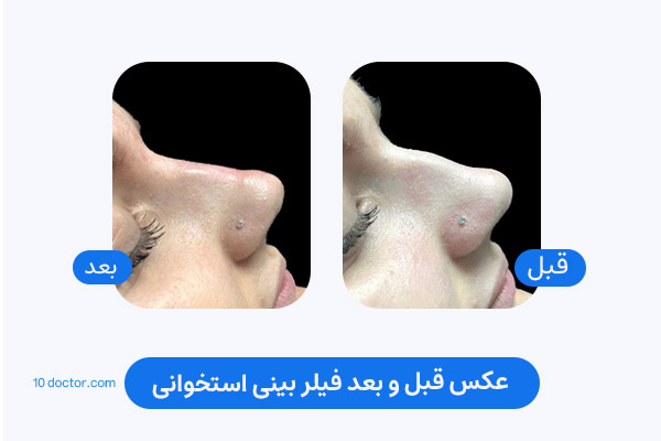 عکس قبل و بعد فیلر بینی استخوانی