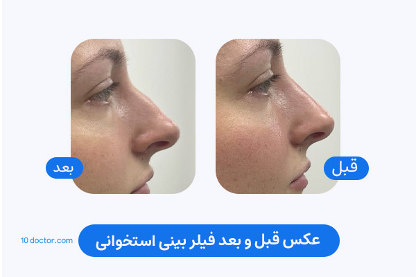 عکس قبل و بعد فیلر بینی استخوانی
