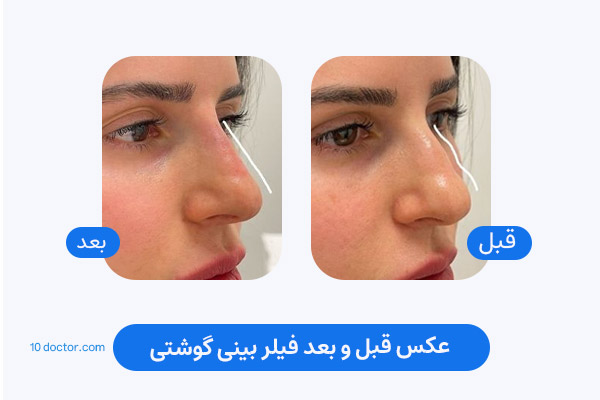 عکس قبل و بعد فیلر بینی گوشتی