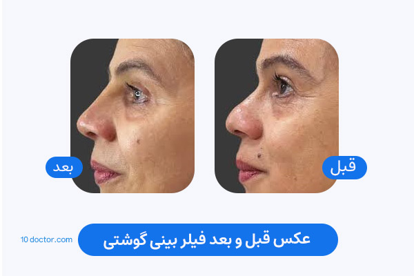 عکس قبل و بعد فیلر بینی گوشتی