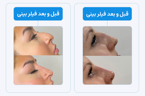 تصاویر قبل و بعد تزریق فیلر بینی در شیراز