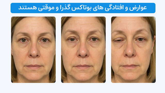 عوارض و افتادگی های بوتاکس گذرا و موقتی هستند.