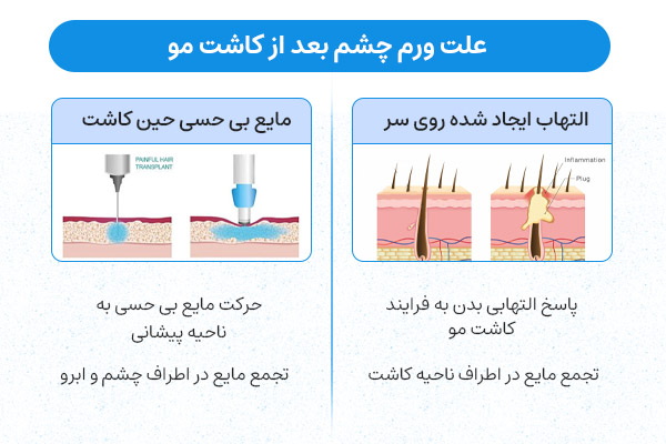 علت ورم چشم بعد از کاشت مو