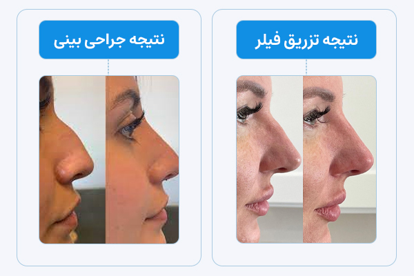 مقایسه تزریق فیلر بینی و جراحی بینی