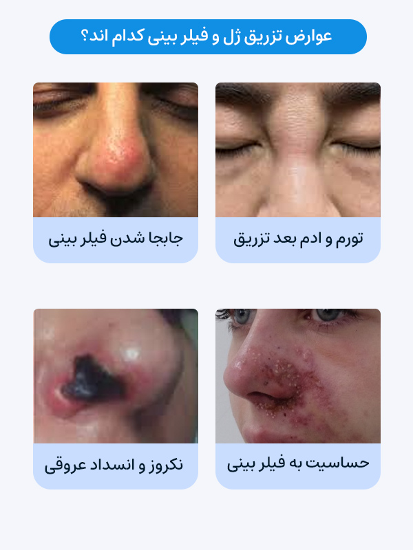 عوارض تزریق فیلر بینی