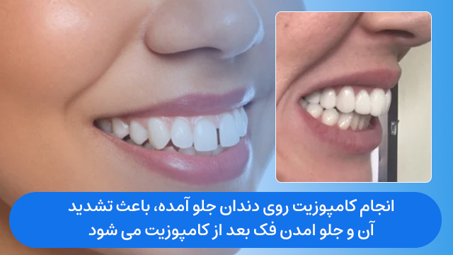 هرچه دندانها نامرتب تر ، کامپوزیت ضخیمتر
