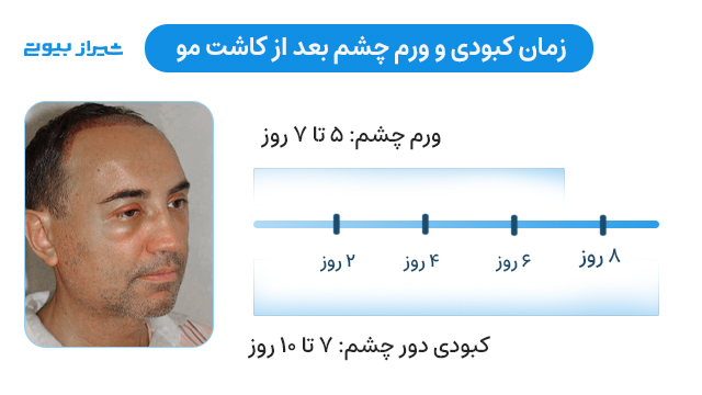 مدت زمان کبودی و ورم چشم بعد از کاشت مو