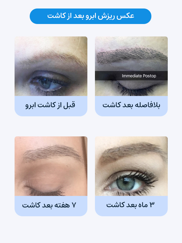 عکس ریزش ابرو بعد از کاشت