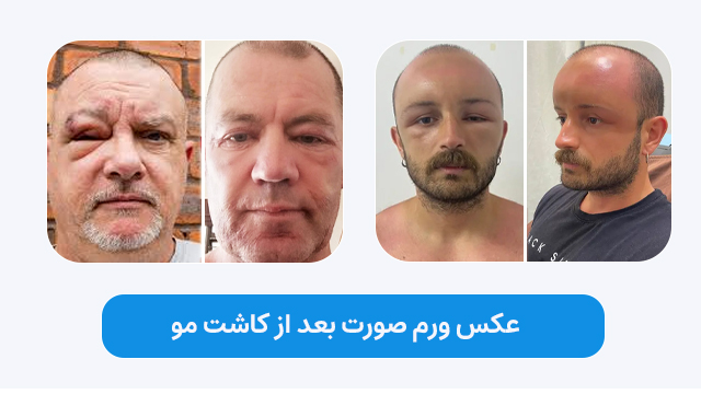 عکس ورم صورت و چشم بعد از کاشت مو