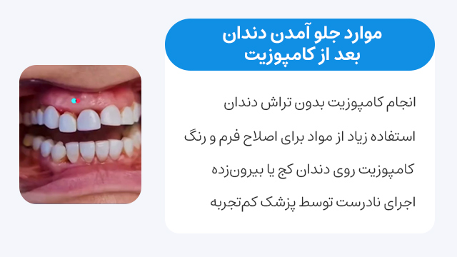 چه زمانی کامپوزیت باعث جلو آمدن دندان میشود؟