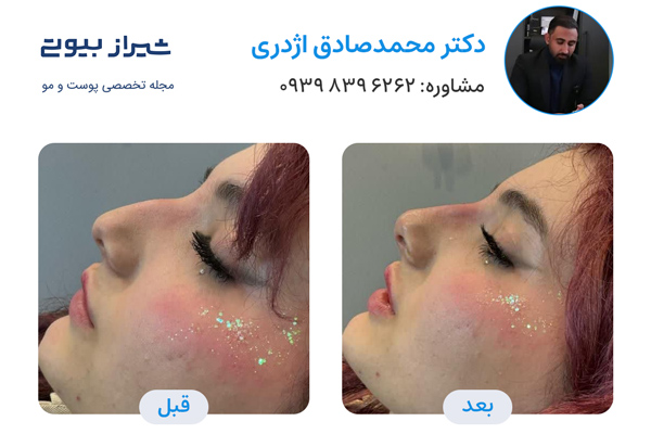 تزریق فیلر بینی در شیراز - دکتر محمدصادق اژدری