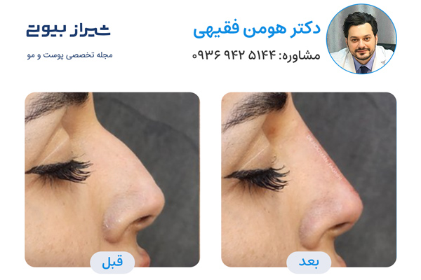 تزریق فیلر بینی در شیراز - دکتر هومن فقیهی