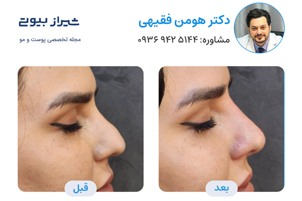 تزریق فیلر بینی در شیراز - دکتر هومن فقیهی