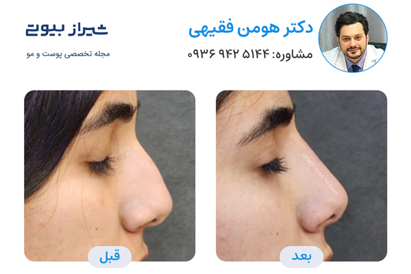 تزریق فیلر بینی در شیراز - دکتر هومن فقیهی