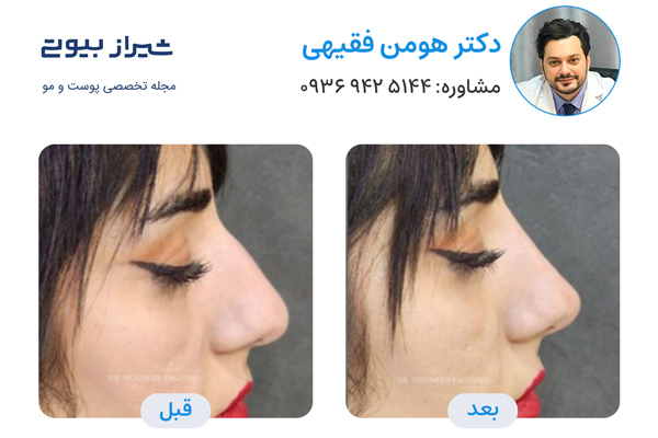تزریق فیلر بینی در شیراز - دکتر هومن فقیهی