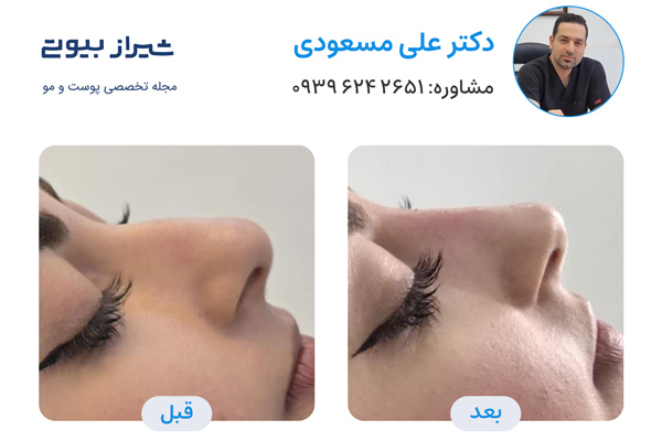 تزریق فیلر بینی در شیراز - دکتر علی مسعودی