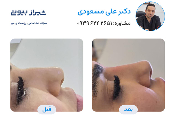 تزریق فیلر بینی در شیراز - دکتر علی مسعودی