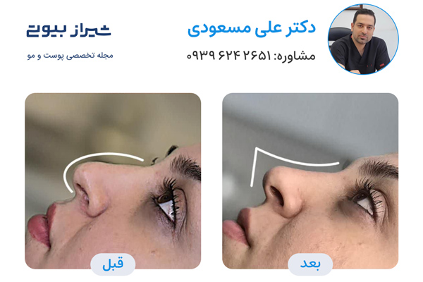 تزریق فیلر بینی در شیراز - دکتر علی مسعودی