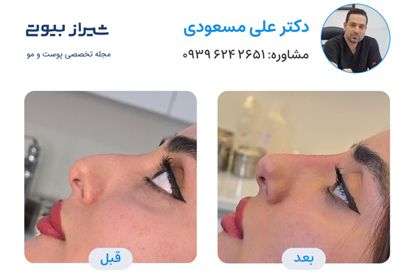 تزریق فیلر بینی در شیراز - دکتر علی مسعودی