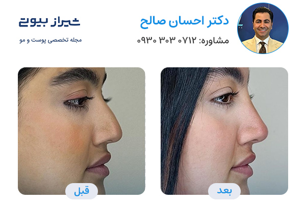تزریق فیلر بینی در شیراز - دکتر احسان صالح