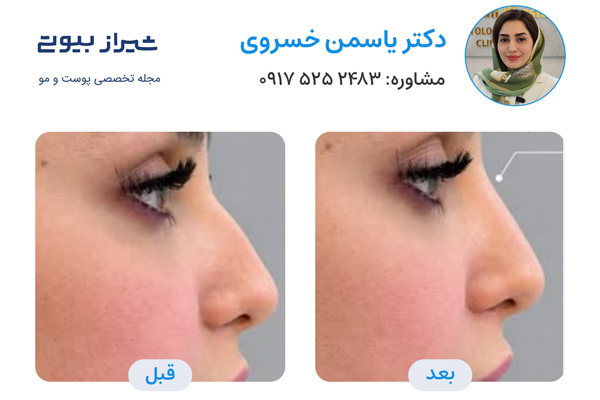 تزریق فیلر بینی در شیراز - دکتر یاسمن خسروی
