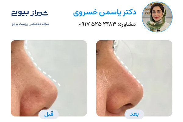 تزریق فیلر بینی در شیراز - دکتر یاسمن خسروی