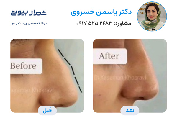 تزریق فیلر بینی در شیراز - دکتر یاسمن خسروی