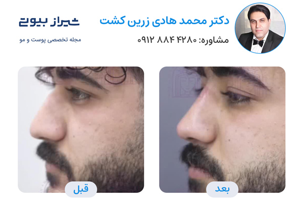 تزریق فیلر بینی در شیراز - دکتر هادی زرین کشت