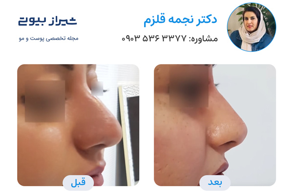تزریق فیلر بینی در شیراز - دکتر نجمه قلزم