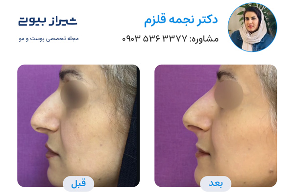 تزریق فیلر بینی در شیراز - دکتر نجمه قلزم