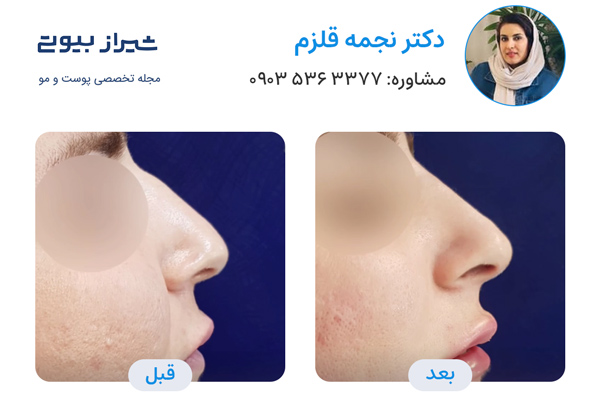 تزریق فیلر بینی در شیراز - دکتر نجمه قلزم