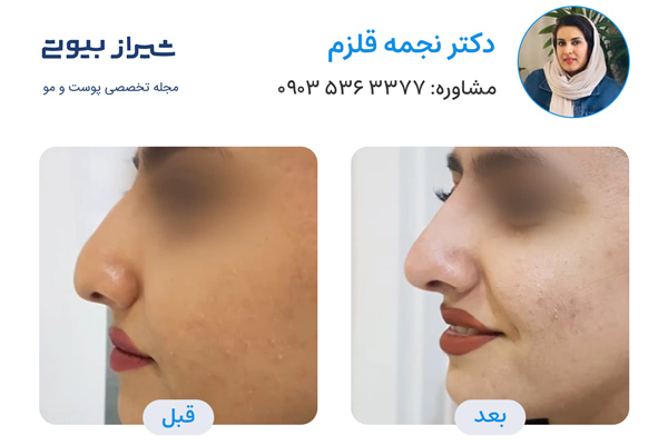 تزریق فیلر بینی در شیراز - دکتر نجمه قلزم