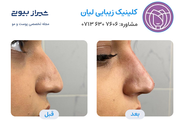 تزریق فیلر بینی در شیراز - کلینیک لیان