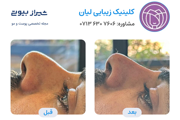 تزریق فیلر بینی در شیراز - کلینیک لیان