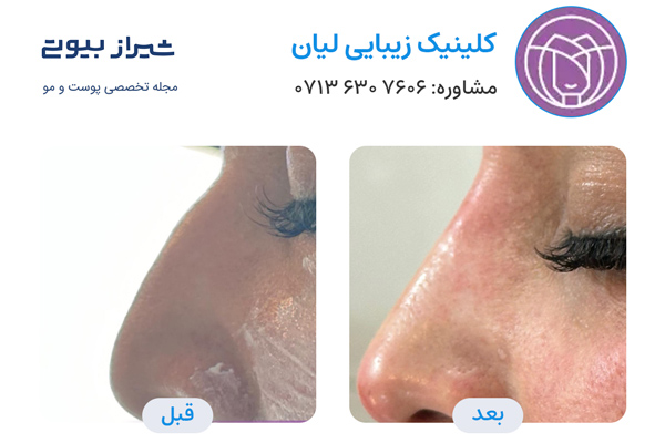 تزریق فیلر بینی در شیراز - کلینیک لیان