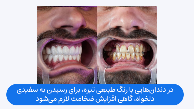در دندانهایی با رنگ طبیعی تیره، برای رسیدن به سفیدی دلخواه، گاهی افزایش ضخامت لازم میشود.