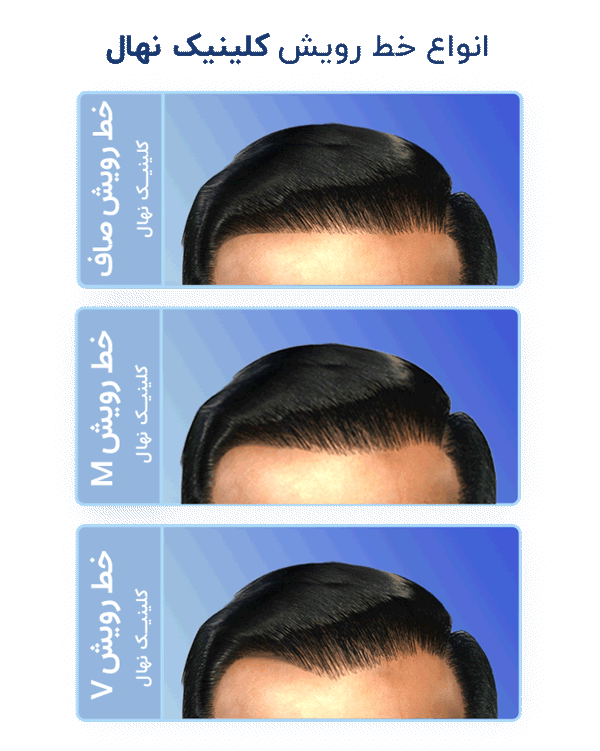 انواع خط رویش