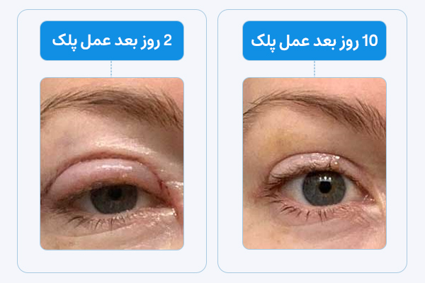 تصاویر قبل و بعد عمل پلک
