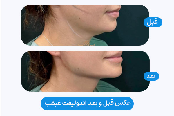 عکس قبل و بعد اندولیفت غبغب