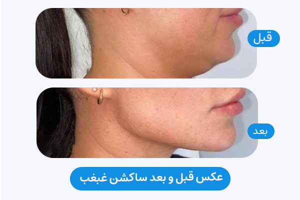 عکس قبل و بعد ساکشن غبغب